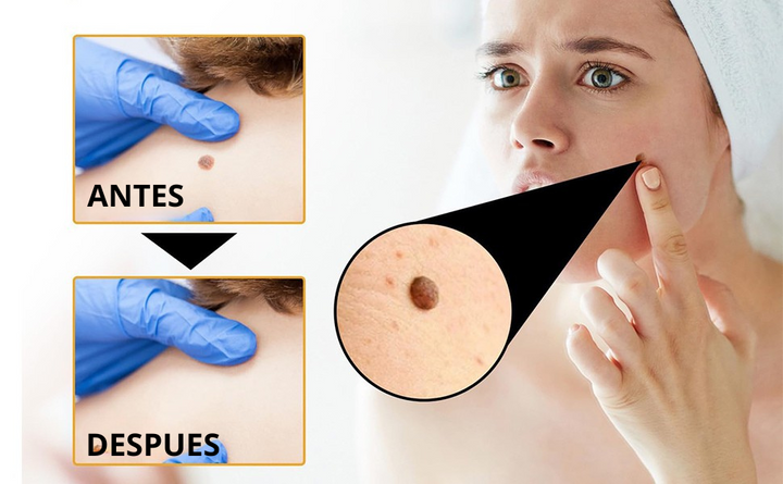 Tag Recede® – Spray Eliminador de Verrugas Despídete de las verrugas y marcas en la piel !