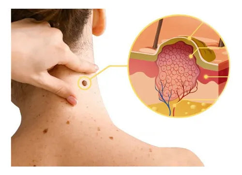 Tag Recede® – Spray Eliminador de Verrugas Despídete de las verrugas y marcas en la piel !