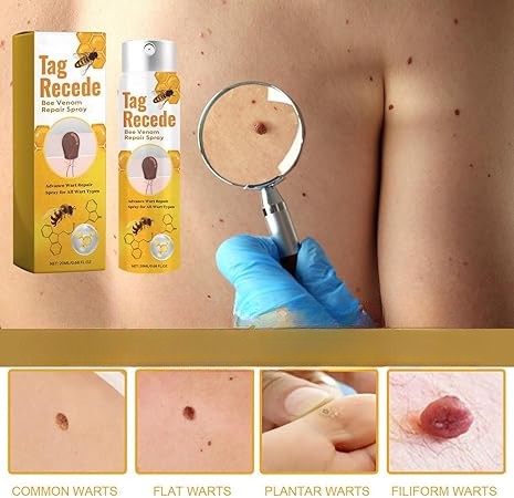 Tag Recede® – Spray Eliminador de Verrugas Despídete de las verrugas y marcas en la piel !
